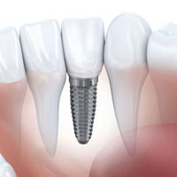 Implantologie Orala